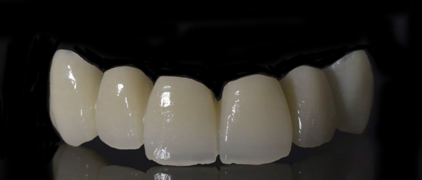 Zirconia monolítica